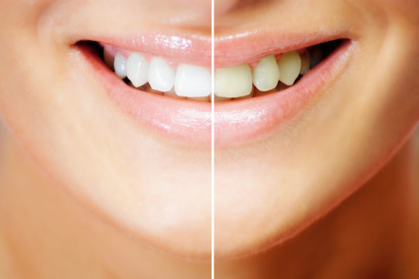 Estética dental en Tirma López Clínica Dental