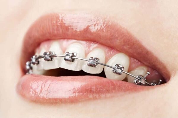 Ortodoncia en Tirma López Clínica Dental