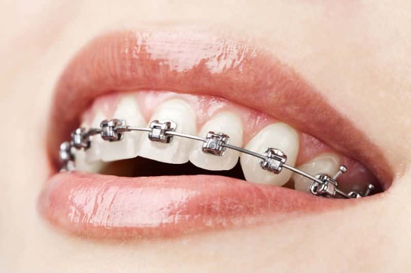 En este momento estás viendo Ortodoncia en Tirma López Clínica Dental