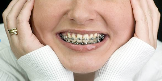 El falso mito de la ortodoncia en adultos