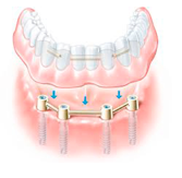 Tipos de prótesis para implantes dentales