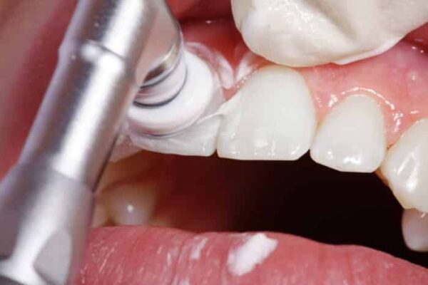 ¿Por qué son necesarias las limpiezas dentales?