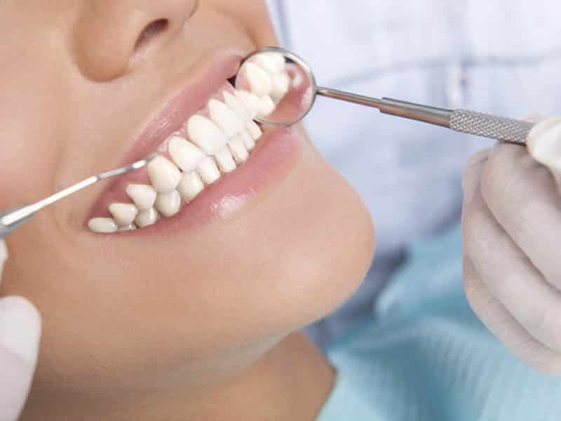 Carillas dentales - ¿Cómo se preparan y se colocan? Porcelana y resina o  composite © 