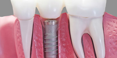 Ventajas de apostar por los implantes dentales, mejora tu sonrisa
