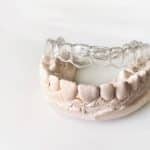 Beneficios de la ortodoncia invisible