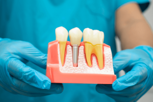 Implantes dentales en Las Palmas: Guía 2025 para recuperar tu sonrisa - tirmalopez