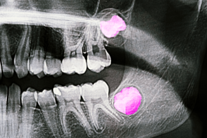 Dentista en Las Palmas revisando una radiografía dental de muelas del juicio en una clínica moderna