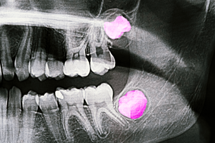 Dentista en Las Palmas revisando una radiografía dental de muelas del juicio en una clínica moderna