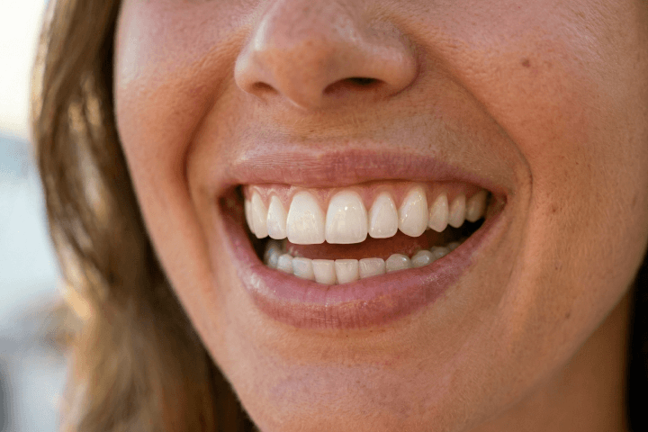 Mejores opciones carillas dentales Las Palmas-Tirma López Mejores opciones para carillas dentales en Las Palmas-Clínica Dental Tirma López Santa Catalina